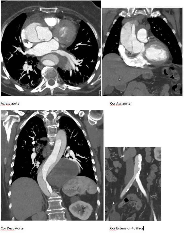SB Type A Dissection CT Images compiled